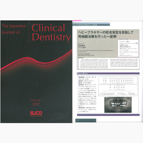 The Japanese Journal of Clinical Dentistry VOLUME3 2017 ヘビーブラキサーの咬合安定を目指して再補綴治療を行った一症例