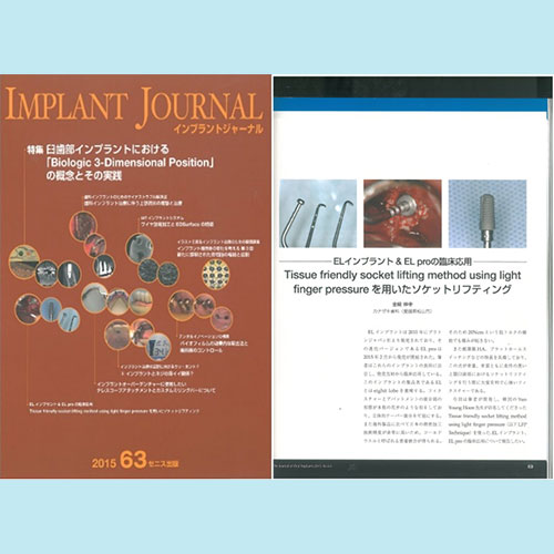 インプラントジャーナル IMPLANT JOURNAL 63号 ELインプラント＆EL proの臨床応用　 Tissue friendly socket lifting method using light finger pressureを用いたソケットリフティング