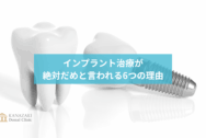 インプラント治療が 絶対だめと言われる6つの理由のアイキャッチ