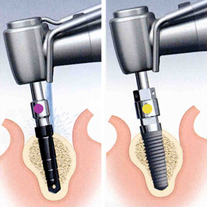 歯肉を切開し、ドリルを使って顎骨に適切な深さと位置、角度に穴をあける