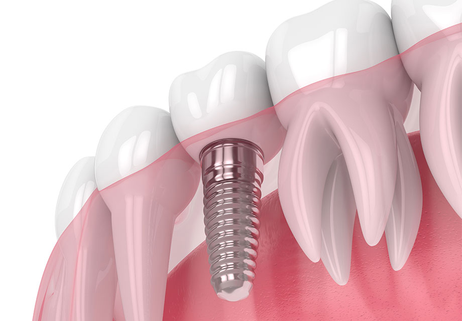 歯肉の移植手術で歯周病菌の侵入を防ぐ